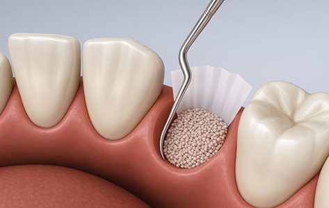 Illustration of bone graft in empty tooth socket