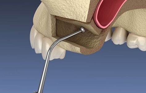 Illustration of sinus lift procedure