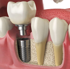 Illustration of dental implant next to natural teeth in jawbone