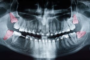 Dental X-ray showing four impacted wisdom teeth