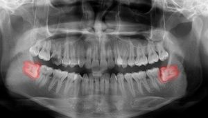X-ray showing two sideways wisdom teeth 
